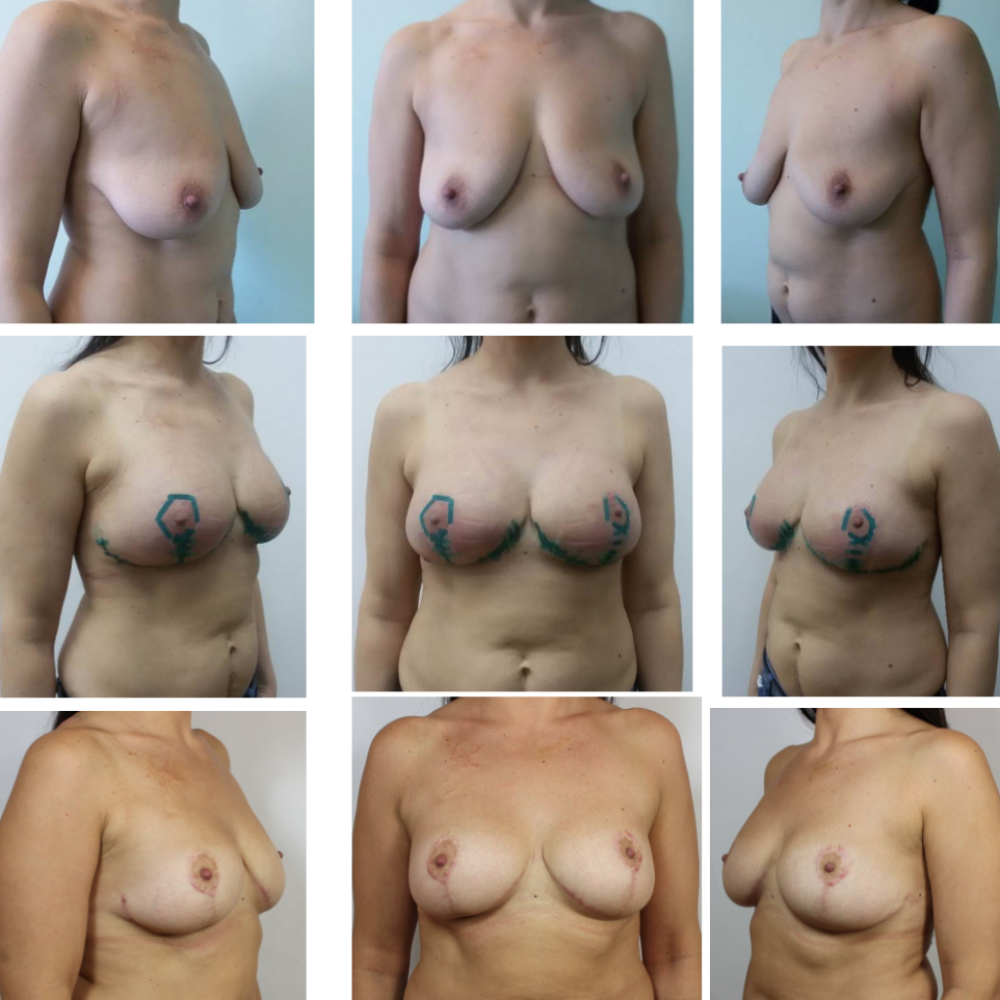Forms of naked female breast