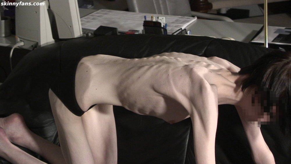 Anna Zholobova anorexia