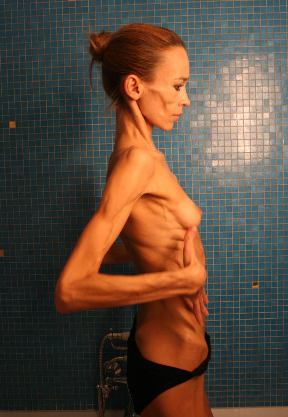 Anorexics without clothes