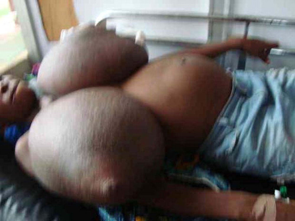 Macromastia of gigantomastia boobs