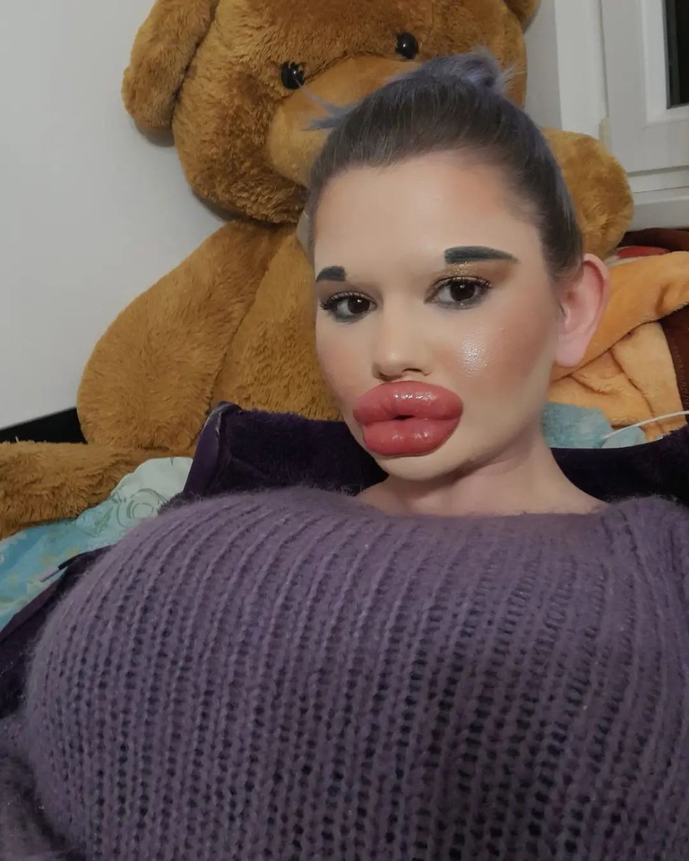 The largest pumped lips in the world