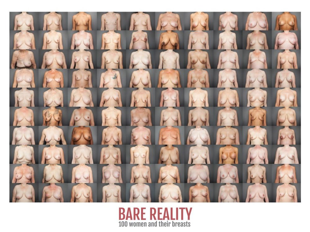 Breast type "East-West