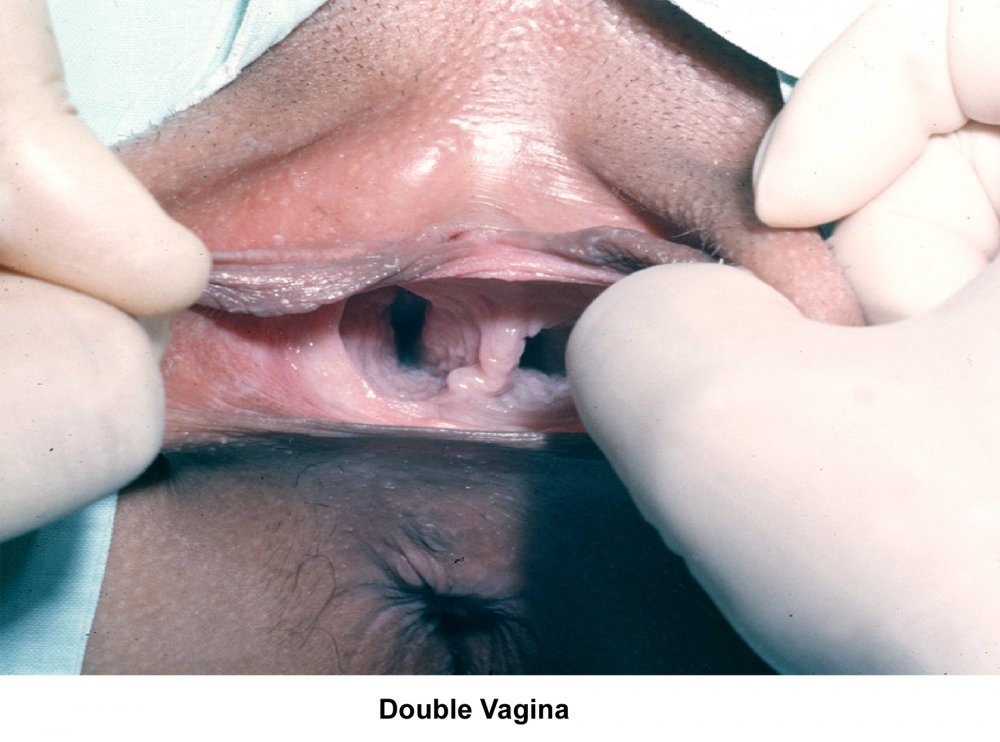 Two vagina at one girl