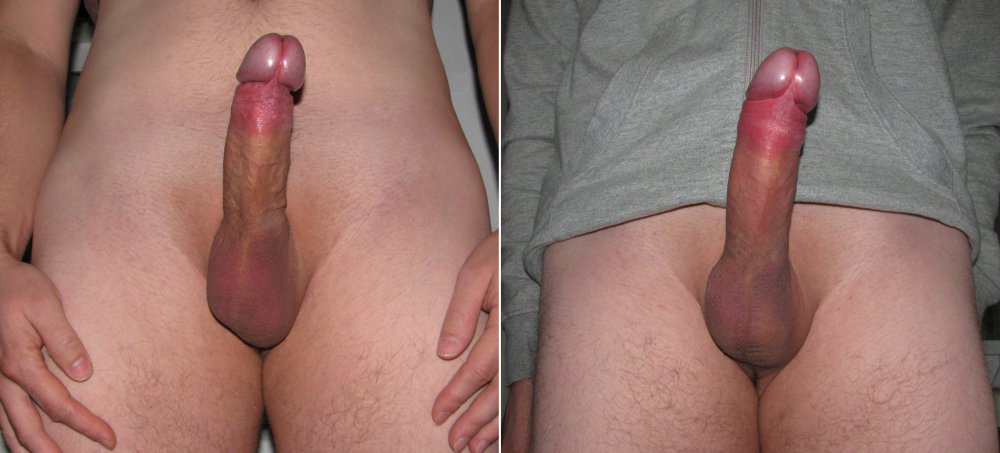 Erection of genital organs