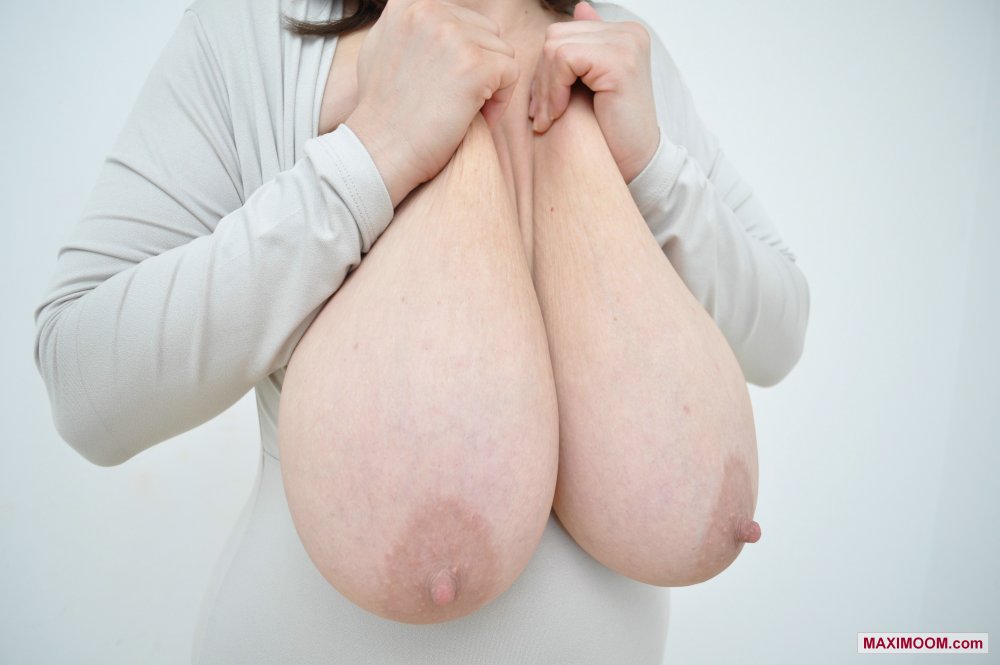 Big breasts of gigantomastia