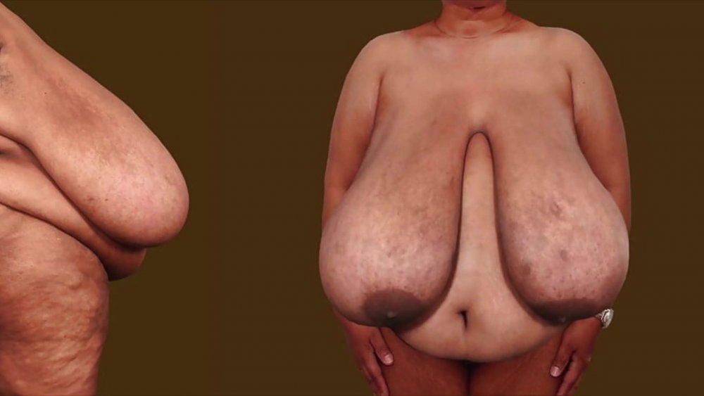 Huge boobs disease