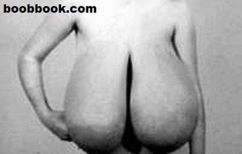 Perthetic macromastia