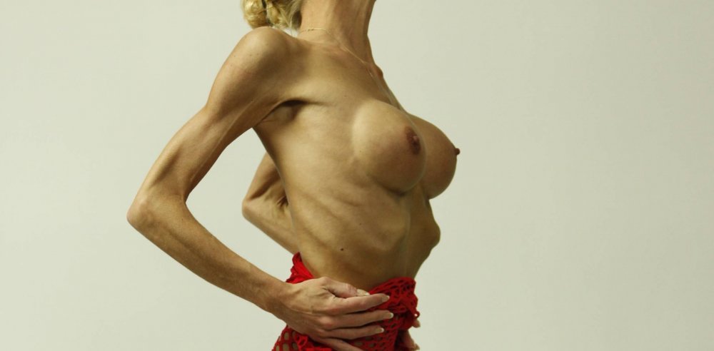 Women Naked anorexia