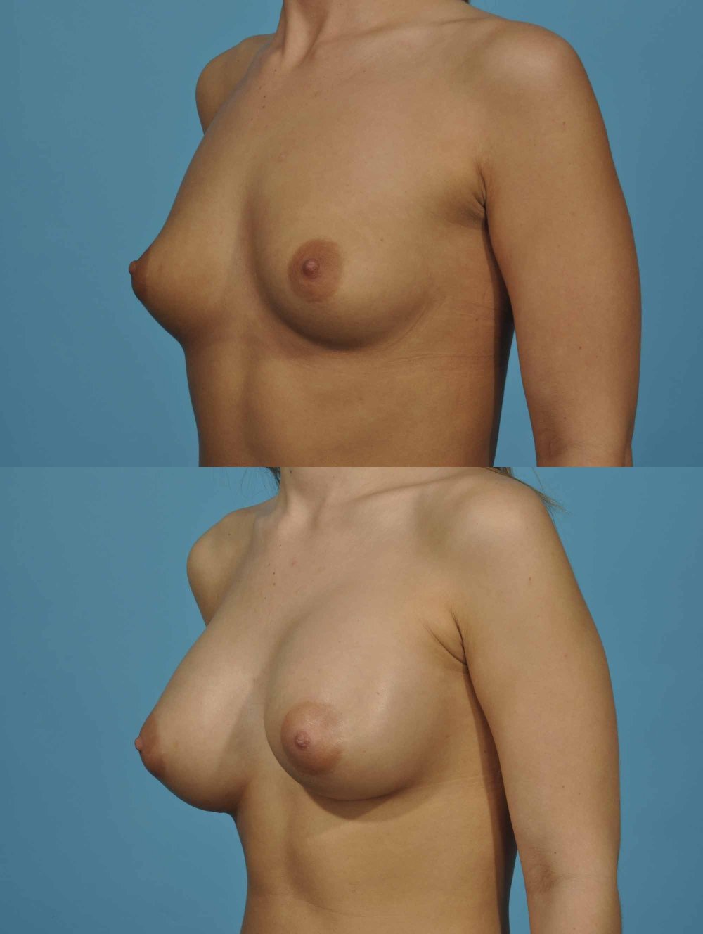Breast plastic