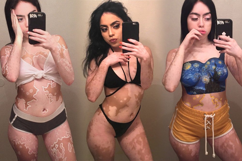 Ashley Soto Vitiligo Naked