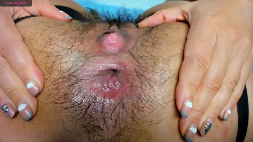 Syphilis on the anus