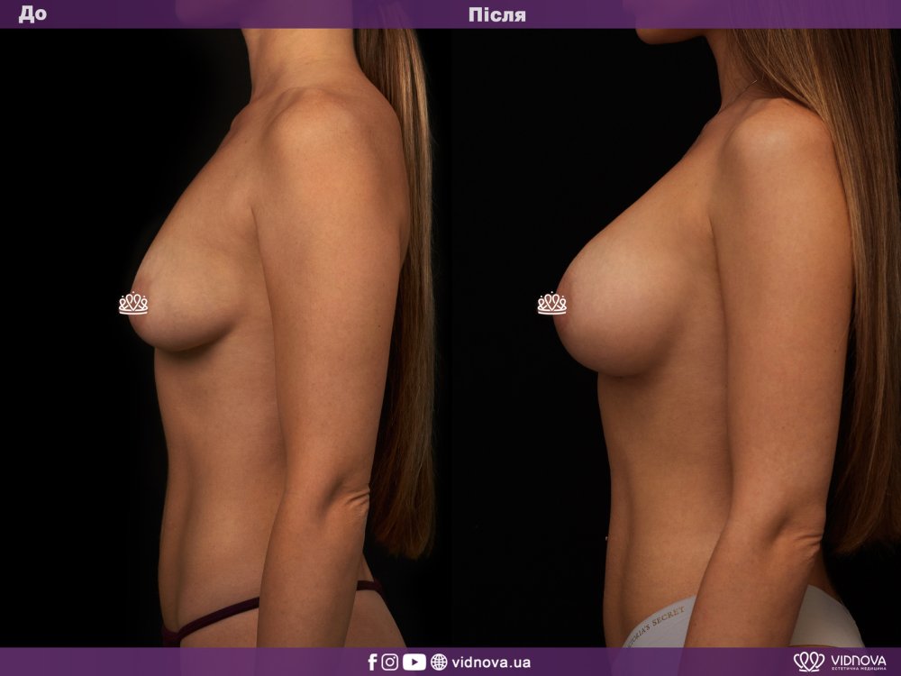 To enlarge the breast