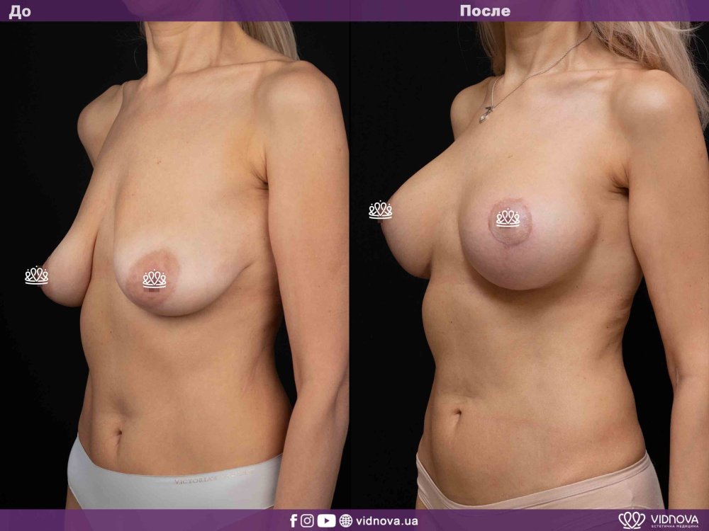 Breast enlargement