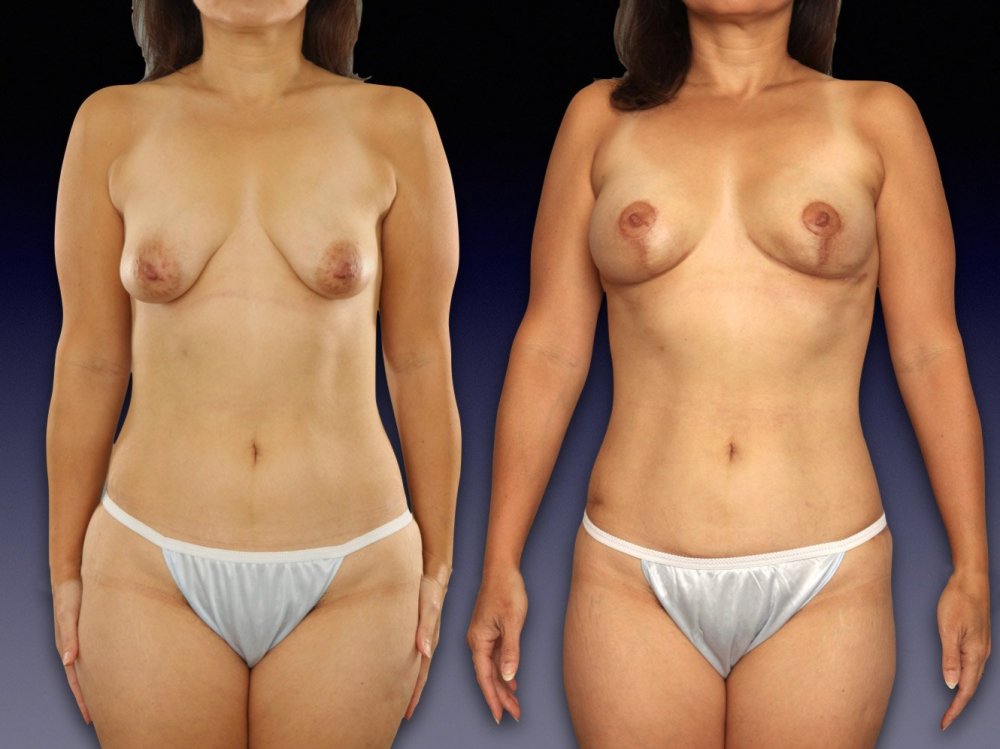 Lipo abdominoplasty