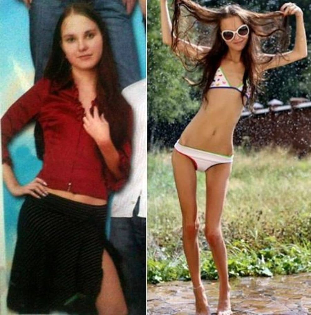 Anna Zholobova anorexia