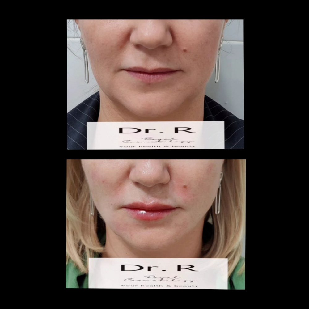 Aptos thread for the upper lip