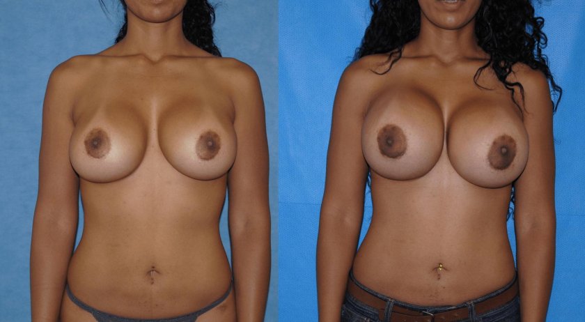 Breast enlargement