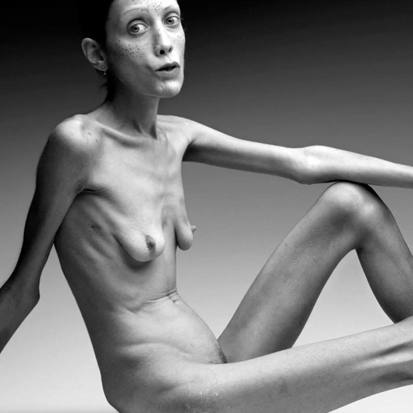 Isabelle Karo anorexia