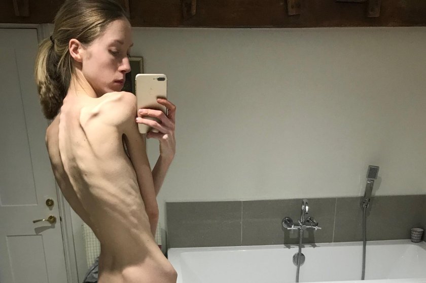 Completely naked anorexica