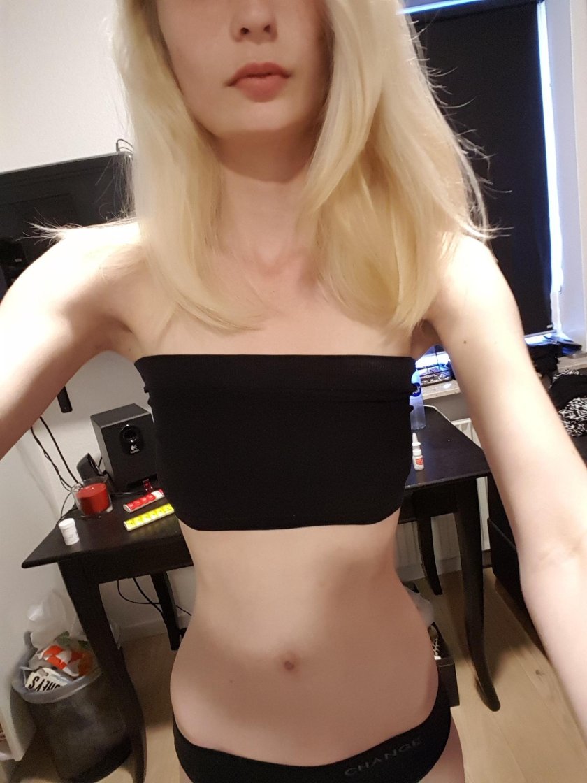 Anorexica with big breasts