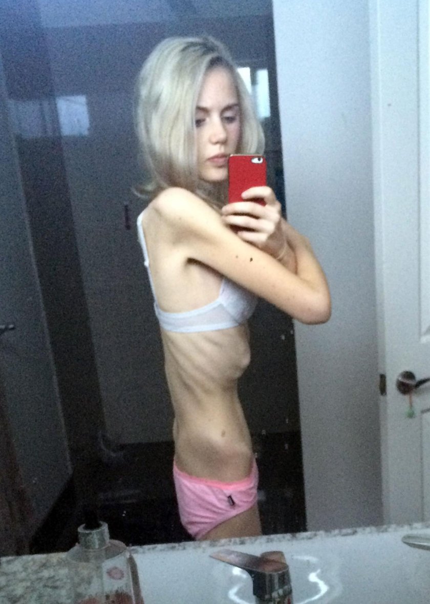 Julia Antipova anorexia