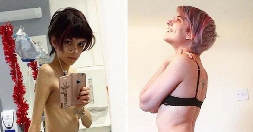 Sierra Bravo Anorexichka