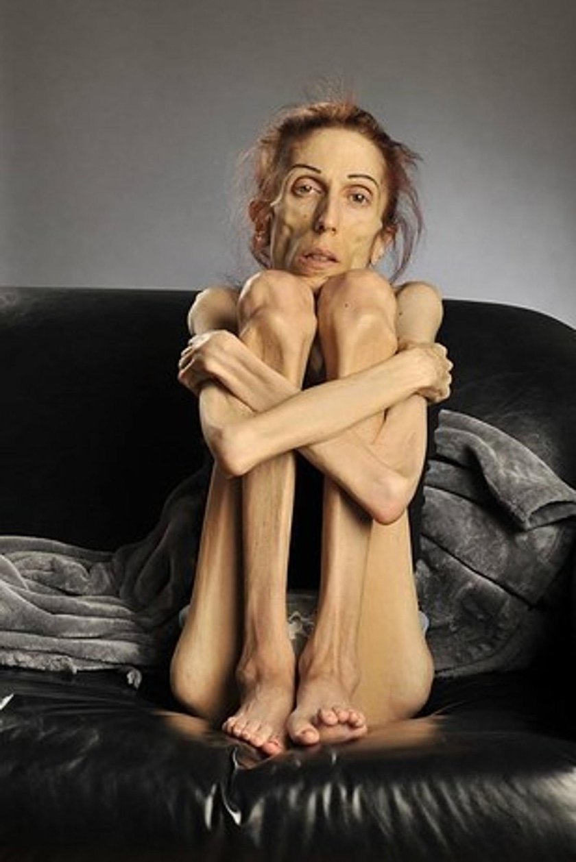 Rachel Farrukh anorexia 2020
