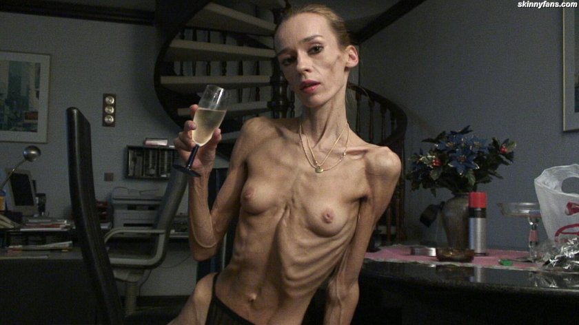 Girl with anorexia