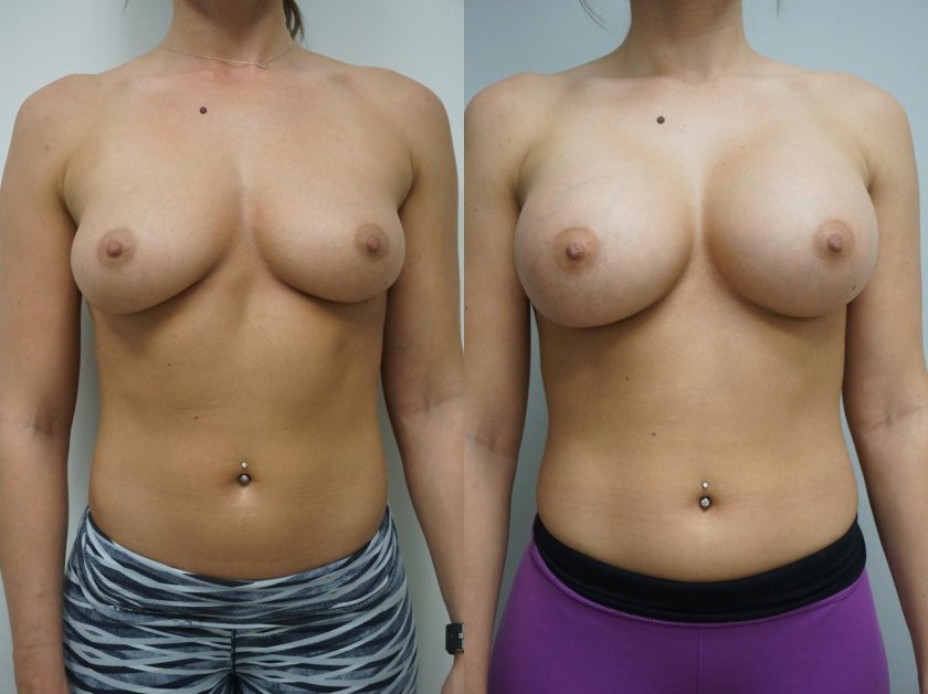 Breast augmentation girls