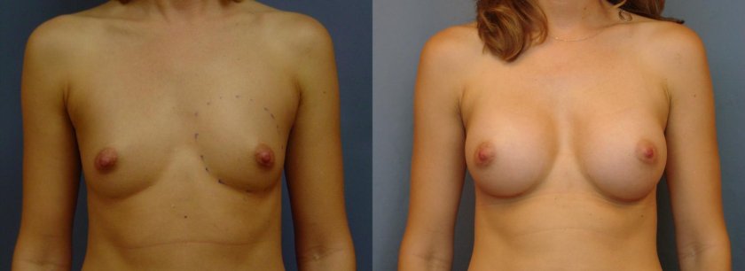 Breast augmentation