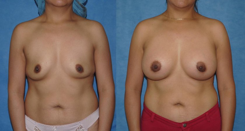 False gynecomastia
