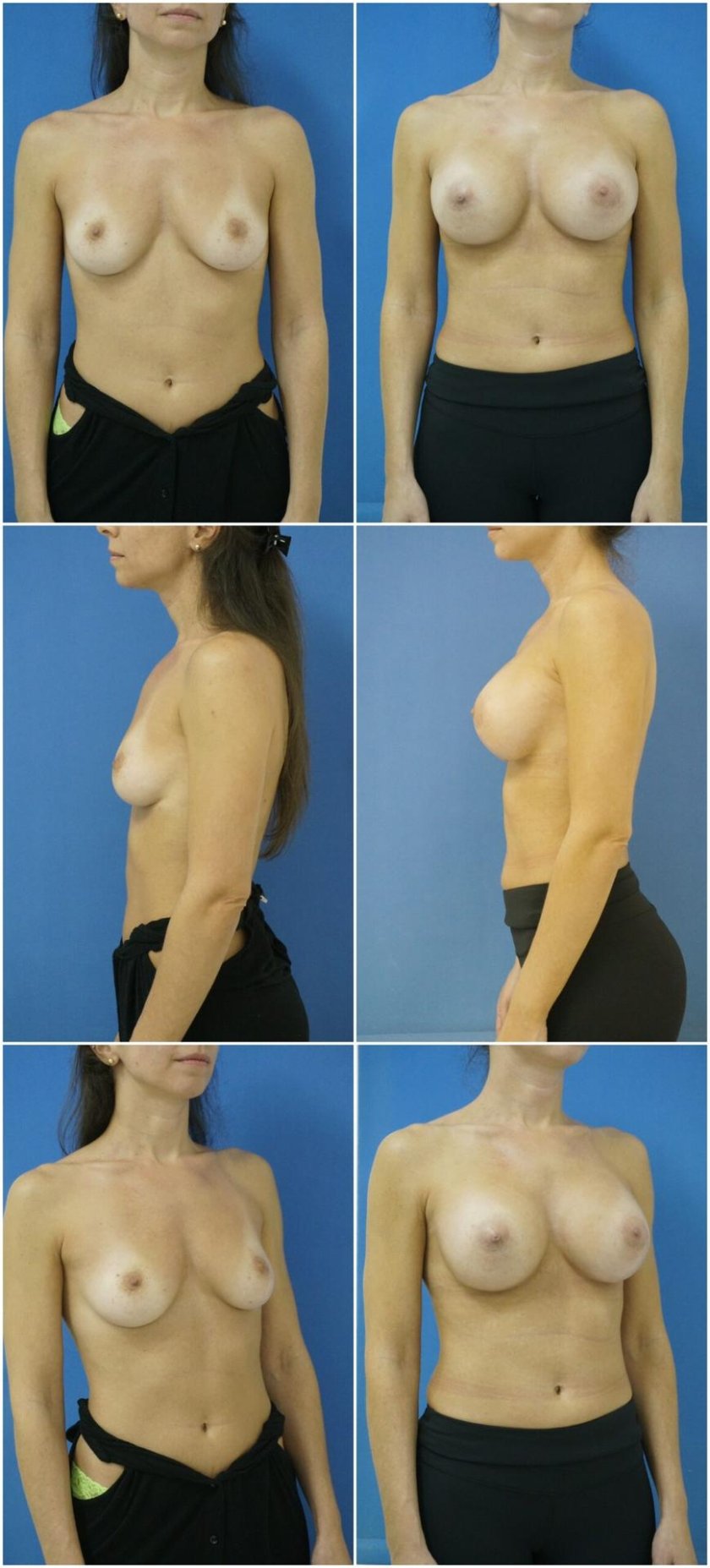 Breast augmentation