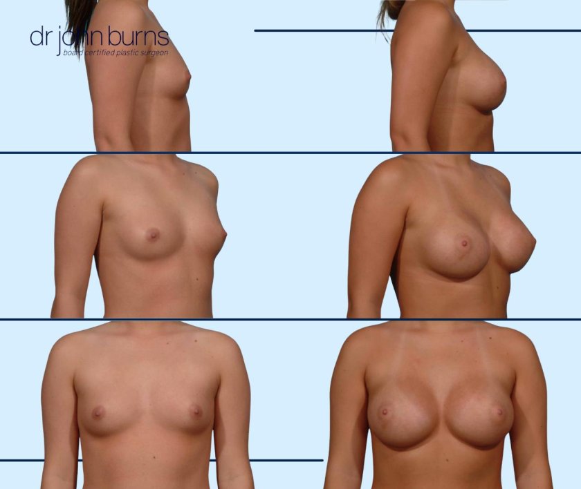Breast augmentation