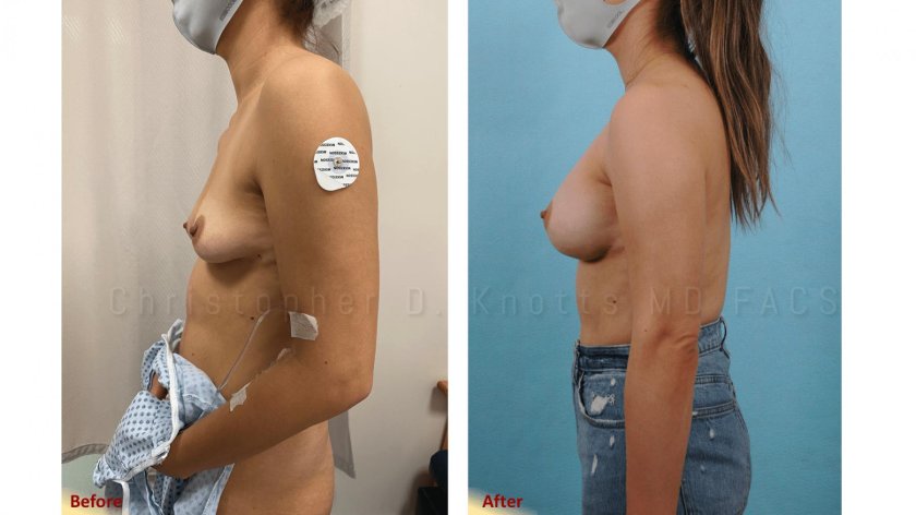 Mammoplasty before and after