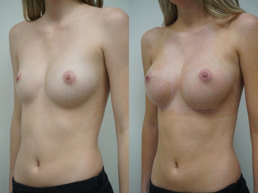 Before and after breast augmentation