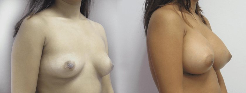 Breast augmentation