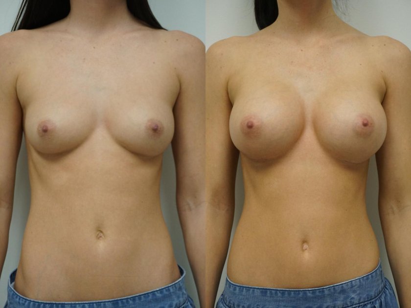 Breast enlargement before and after topless