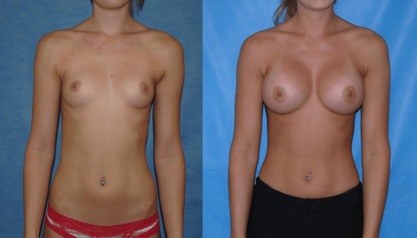 Breast augmentation