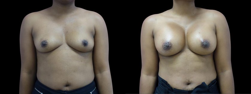 False gynecomastia