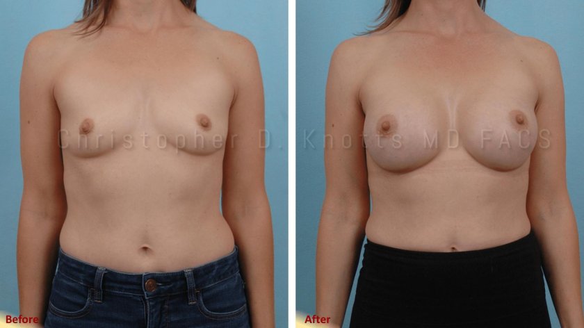 Patriol gynecomastia