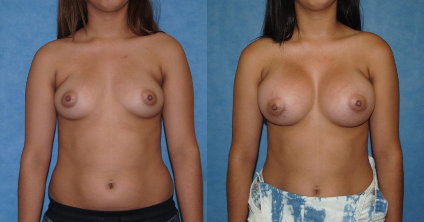 Breast enlargement