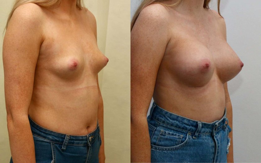Before and after breast augmentation