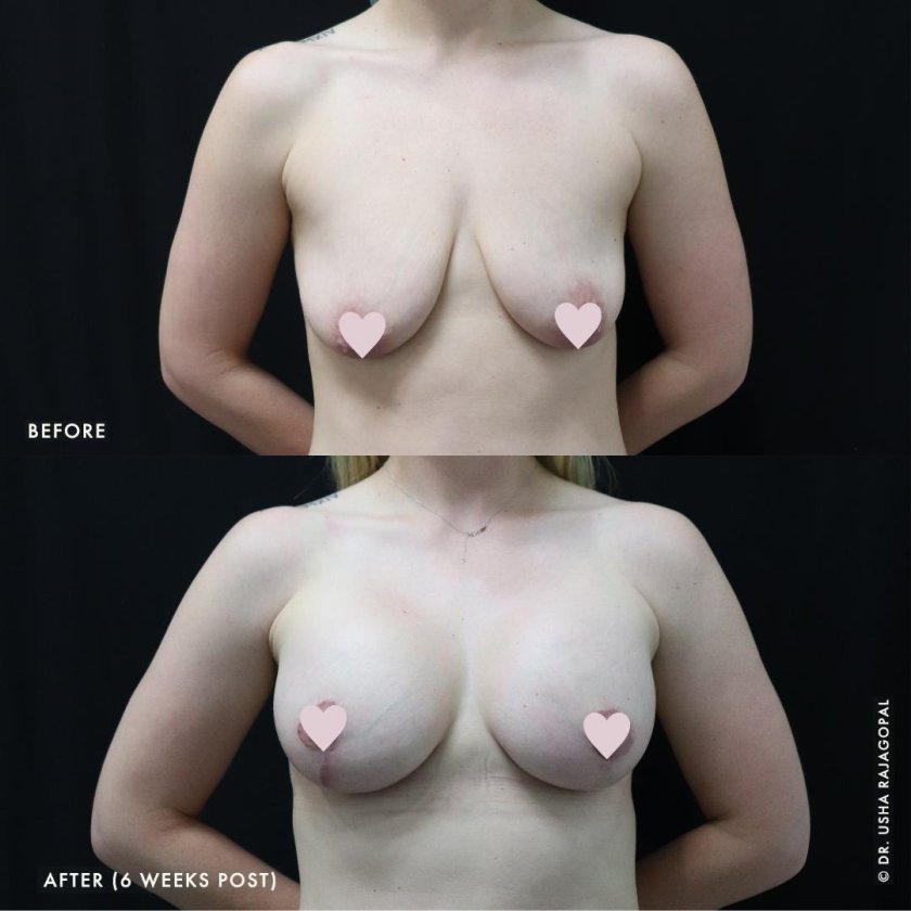 To enlarge the breast