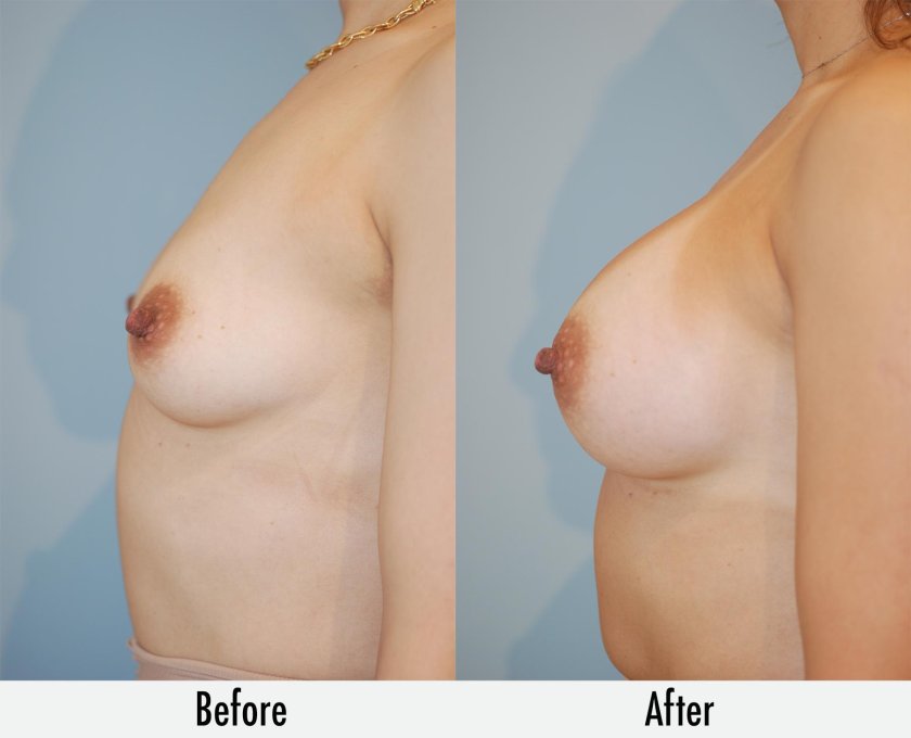 Breasts after plastic