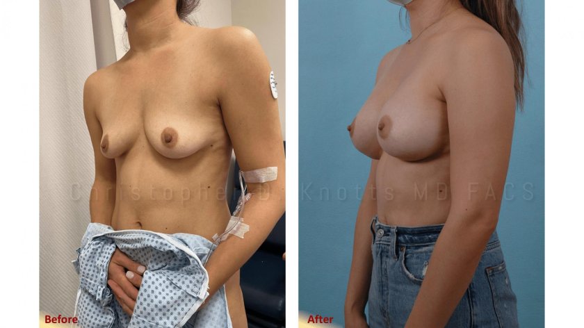 Breasts after implantation