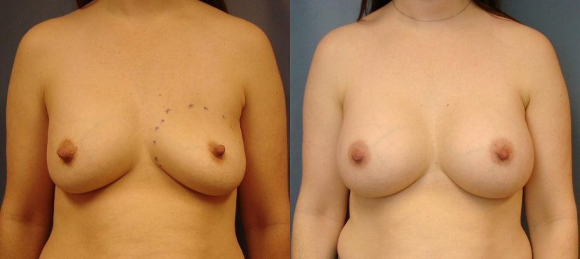 Gynecomastia liposuction