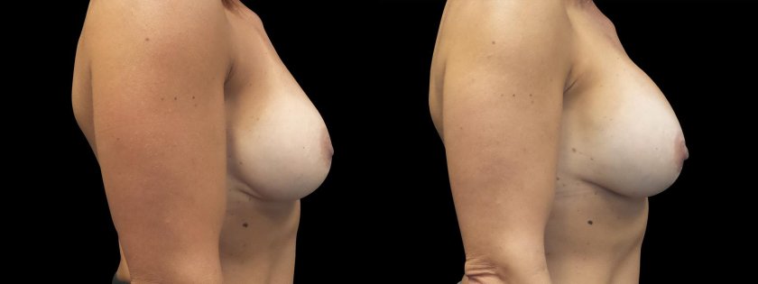 Breast enlargement with fillers