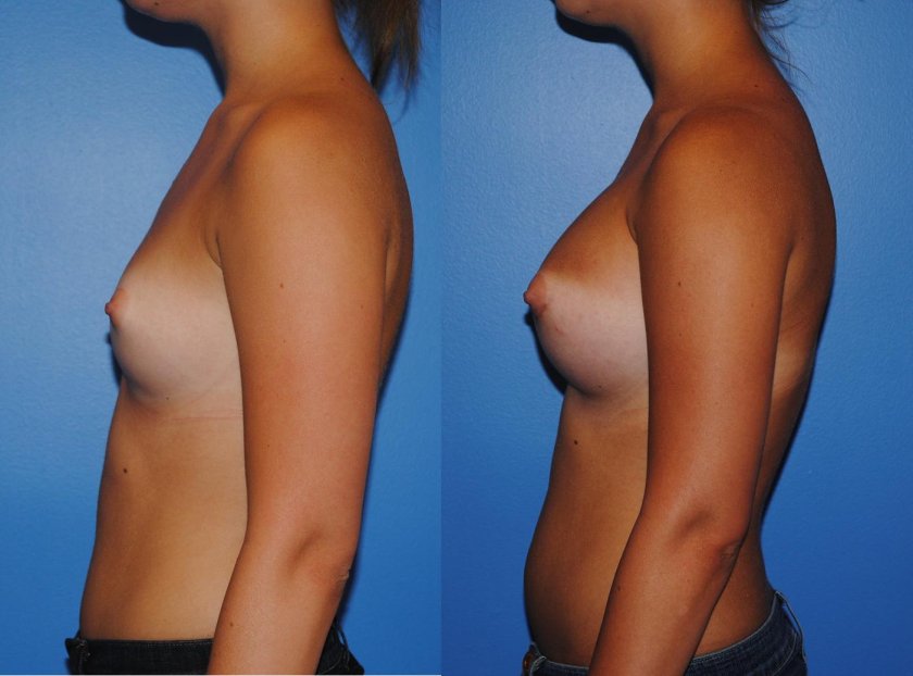 Puberty Small Breasts Little Breast