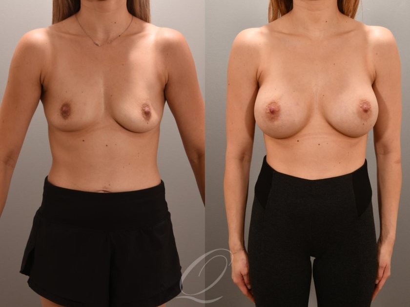 Breasts after implantation