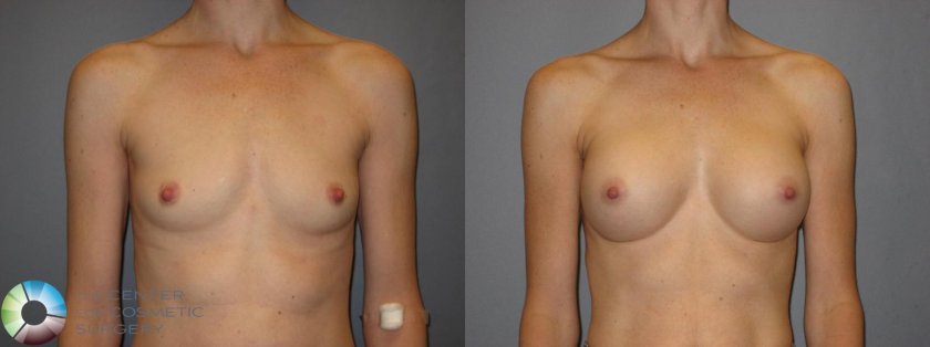 Male breast plastic